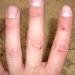 Meine Finger nach dem ersten Tag Klettern